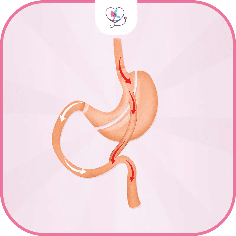 Prix du bypass gastrique en Turquie