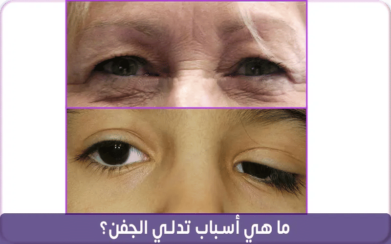 ما هي أسباب تدلي الجفن؟