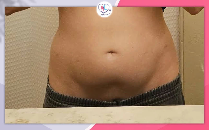 بطني منفوخ بعد عملية شد البطن، هل هذا طبيعي؟ بطني منفوخ بعد عملية شد البطن، هل هذا طبيعي؟