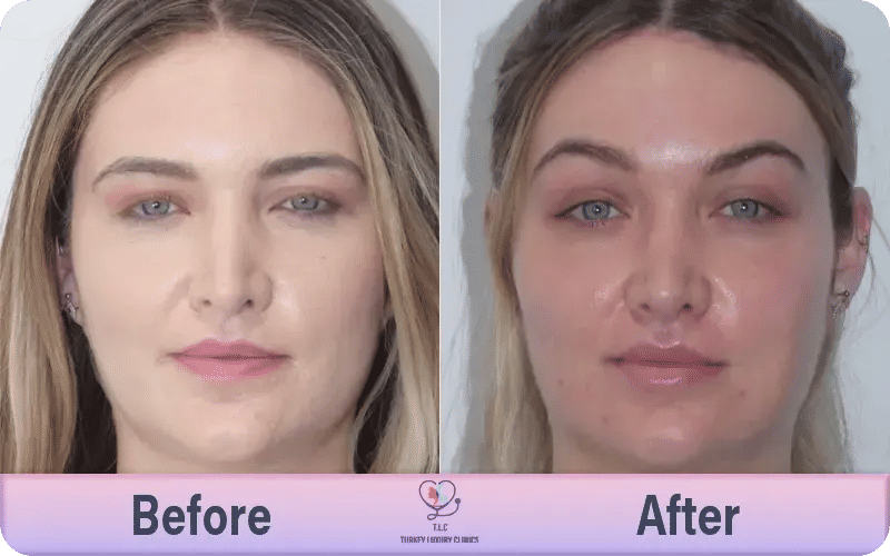 Preventing Botox Brow Lift Mistakes