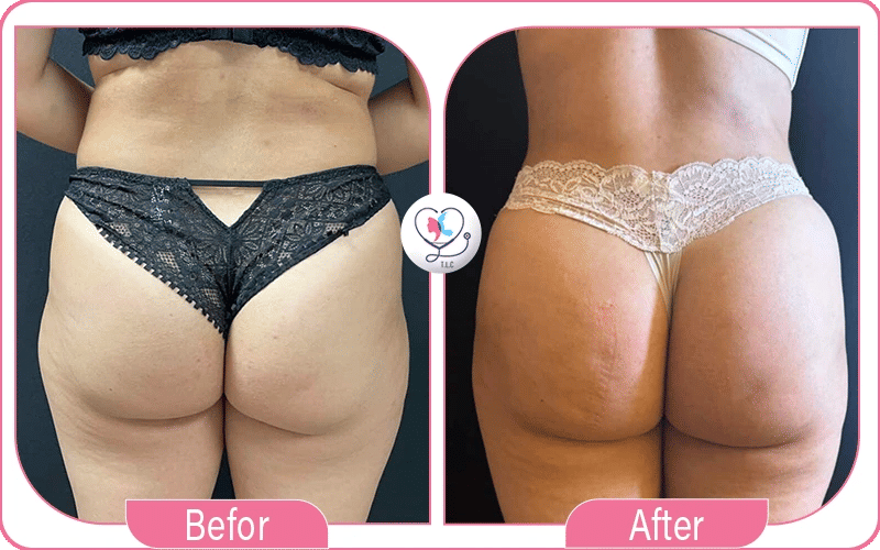 Lipofilling fessier avant / après-3