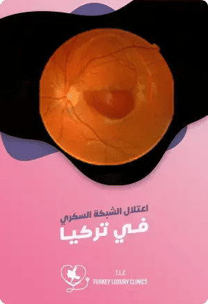 علاج اعتلال الشبكية السكري في تركياfeatured image