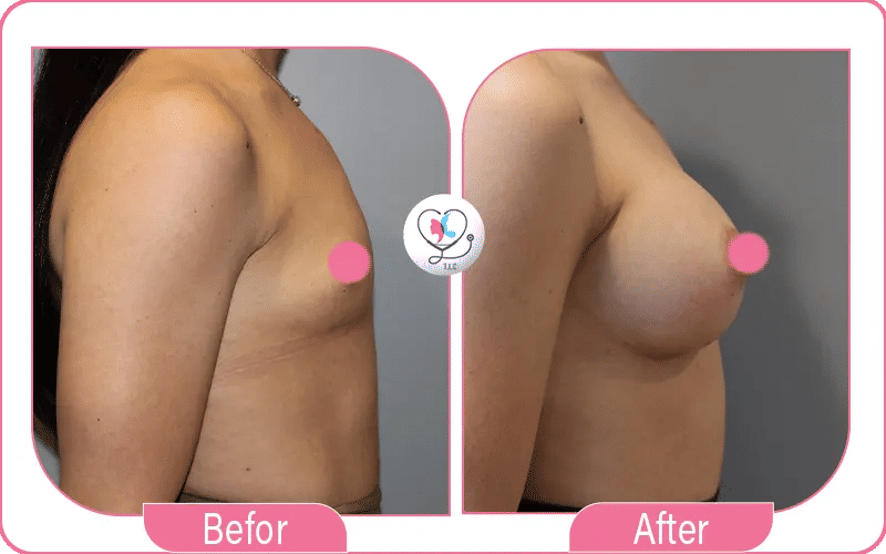 تجربتي مع شد الثدي بالليزر