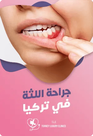 جراحة اللثة في تركيا: الأنواع والتكلفةfeatured image
