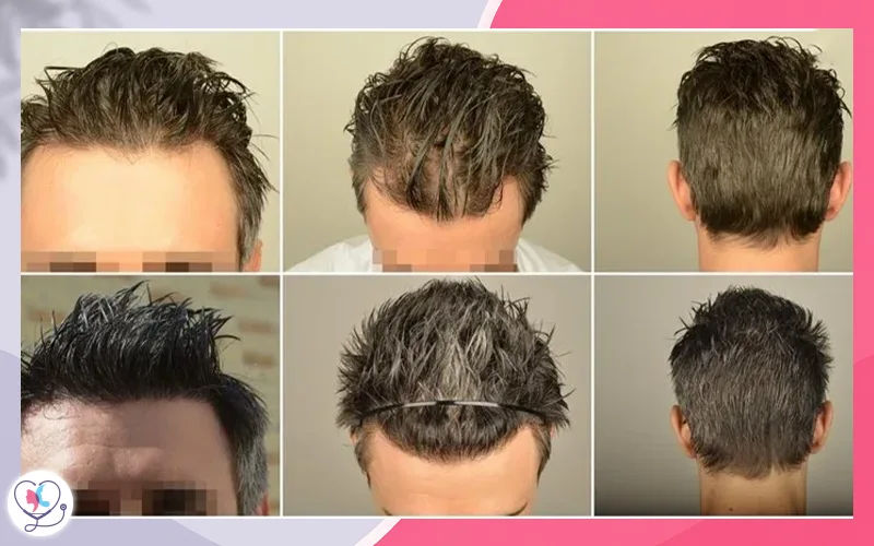 Stage 2 of Hair Loss Stage 2 of Hair Loss