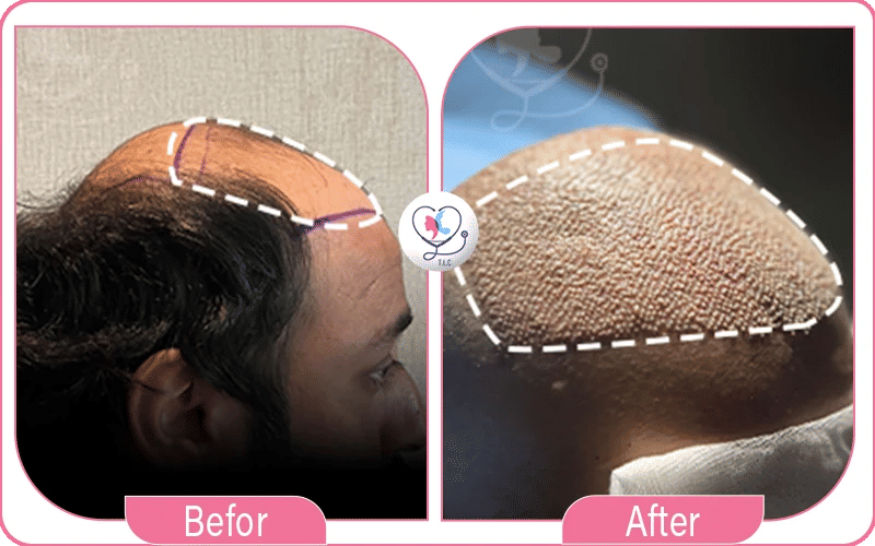 ثانياً: التّقنيات المستخدمة في زراعة الشعر