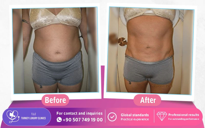 Laser Liposuction Before and After Photos
