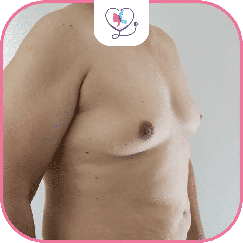 Gynécomastie en Turquie