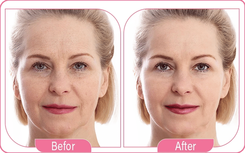 mesotherapie avant apres