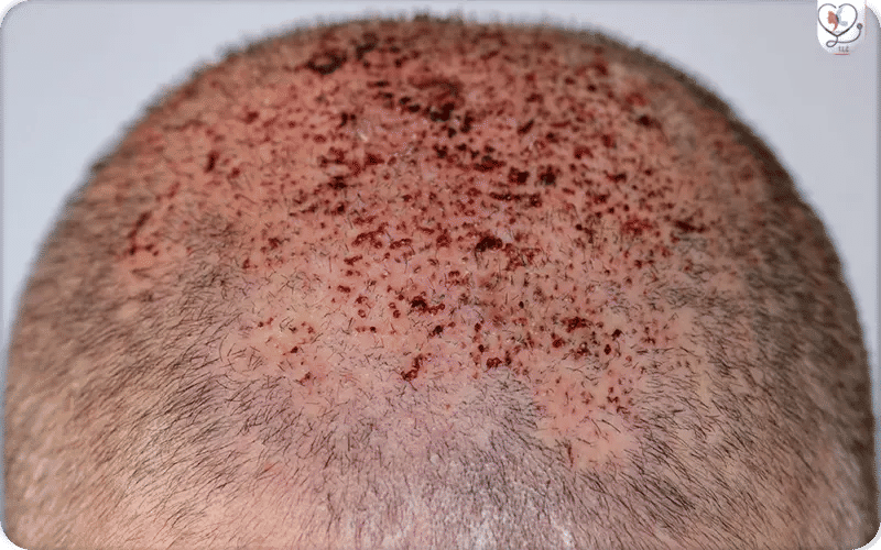 ثانياً: المخاطر والمضاعفات الأقل شيوعاً-2