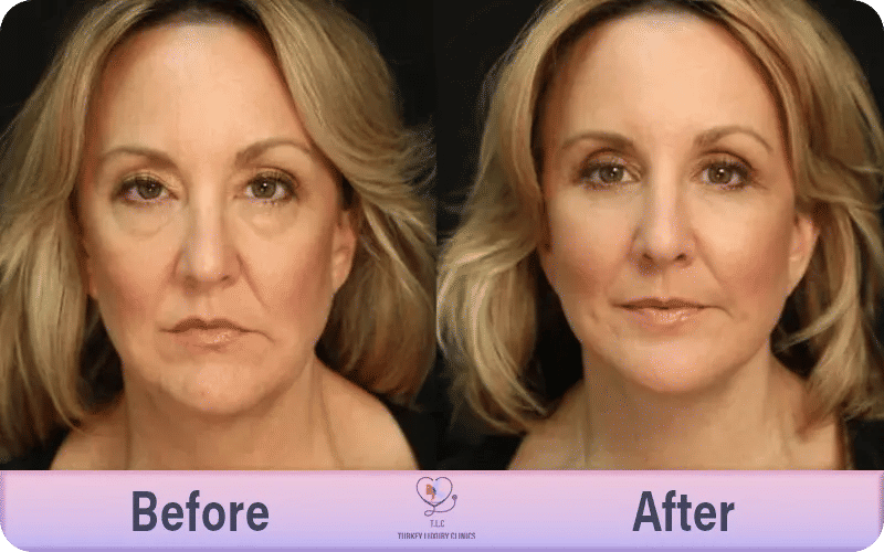  شد الوجه بالليزر في تركيا