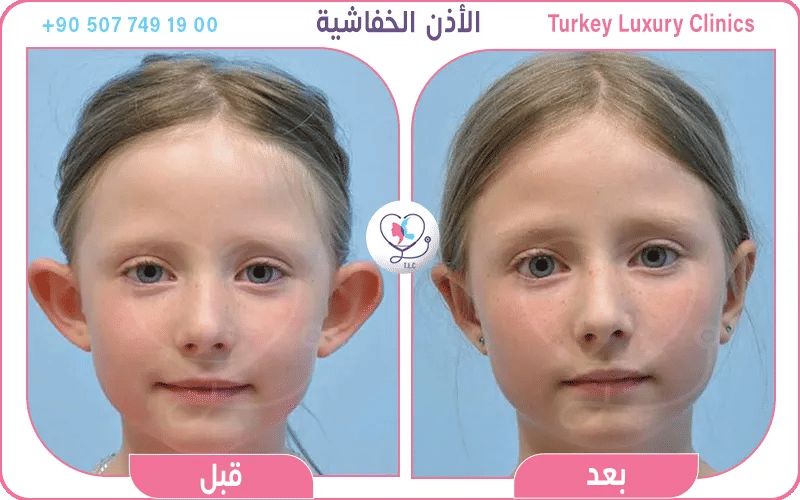 عملية تجميل الأذن (Otoplasty)