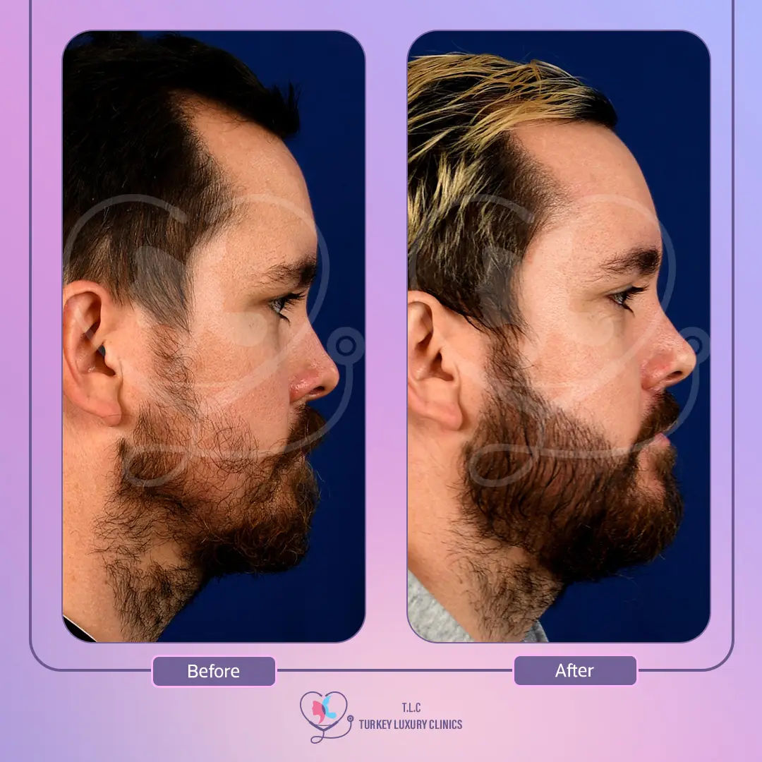 Greffe barbe en Turquie : Prix DHI & photos - Devis Gratuit 