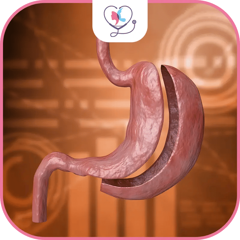 ما الفرق بين تكميم المعدة وتحويل مسار المعدة