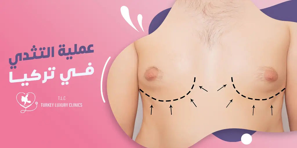 عملية التثدي عند الرجال في تركيا