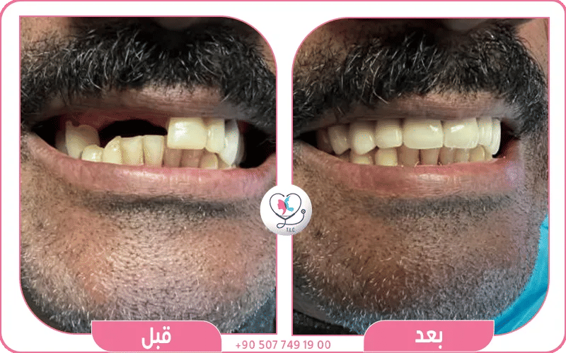 تركيب الجسر النهائي