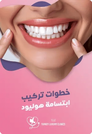 خطوات تركيب ابتسامة هوليودfeatured image