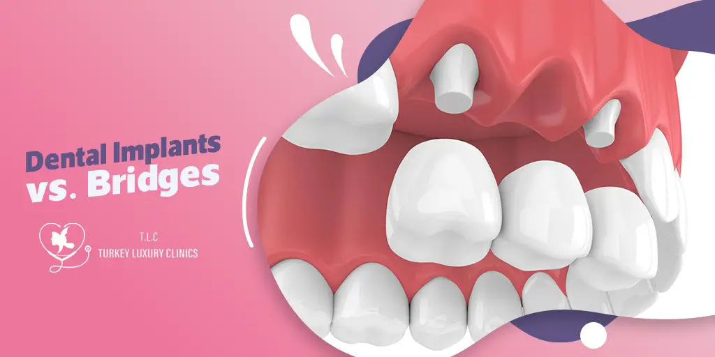 Dental Implants vs. Bridges: Finding the Best Solution for Your Unique Needs