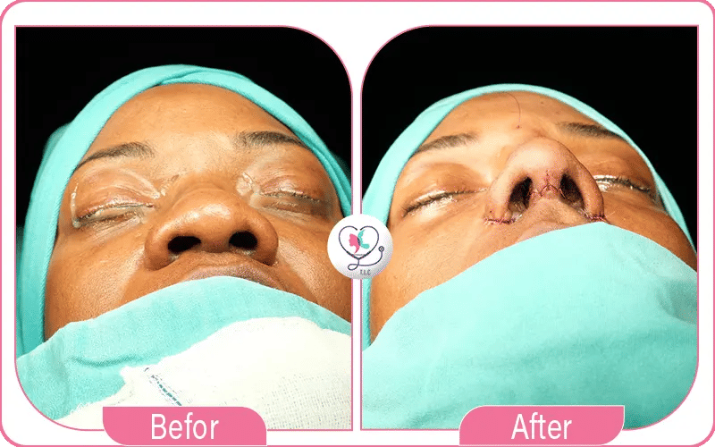 عملية تجميل الأنف الأفطس