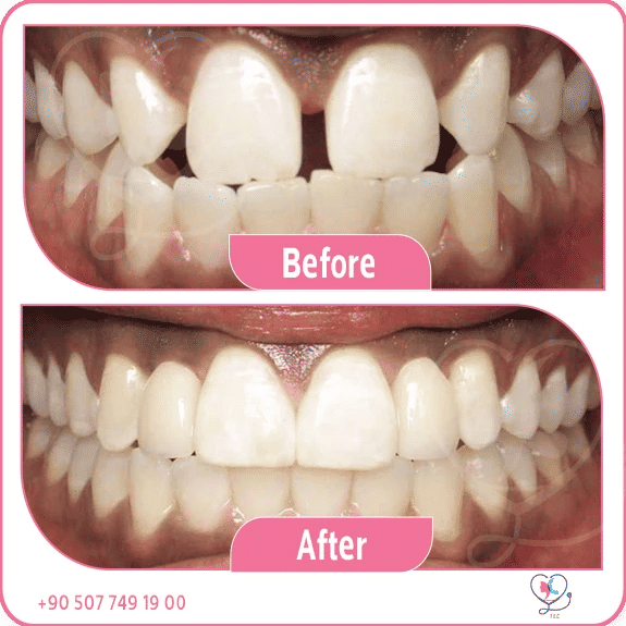Dental implants before and after Turkey – full mouth restoration before and after photos at Turkey Luxury Clinics