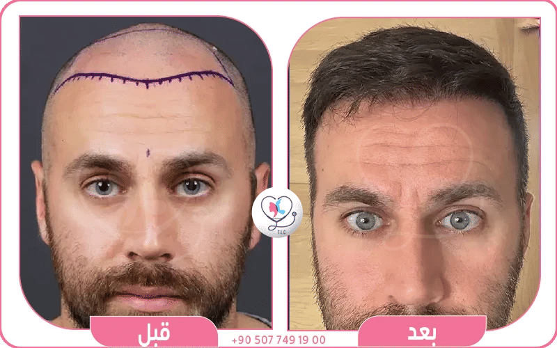 تكلفة تجربتي مع تقنية الخلايا الجذعية للشعر تكلفة تجربتي مع تقنية الخلايا الجذعية للشعر