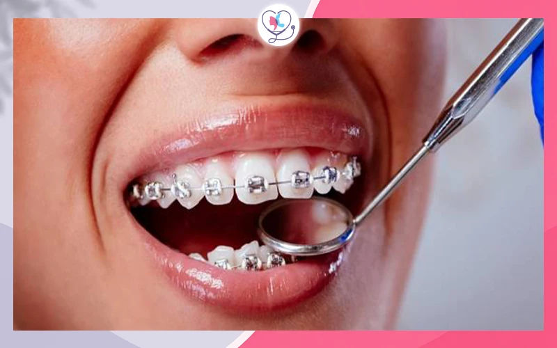 أثناء العلاج