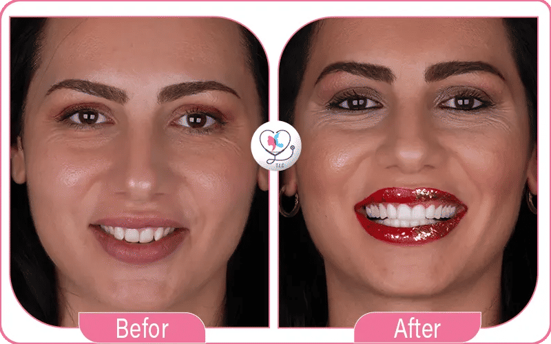 قرار تجربتي مع تبييض الأسنان بالليزر لإزالة اصفرار الأسنان