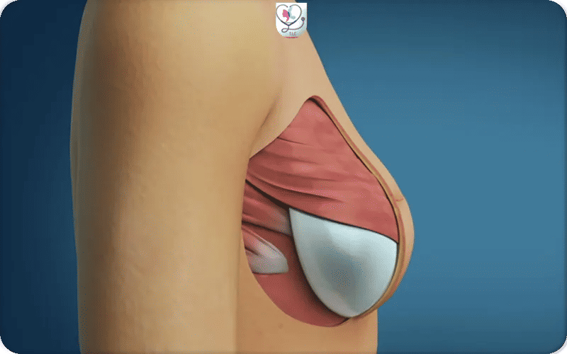 Les différentes techniques de reconstruction mammaire