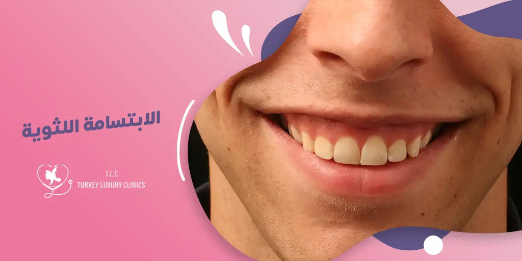 الابتسامة اللثوية: أسبابها وطرق علاجها للحصول على ابتسامة طبيعية