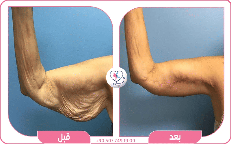 الحلول الجراحية للترهل الشديد