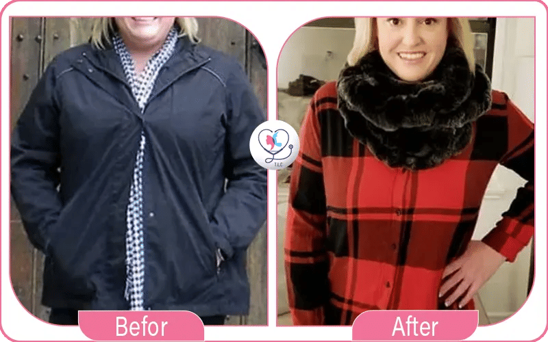 النظام الغذائي بعد تجربتي مع بوتكس المعدة