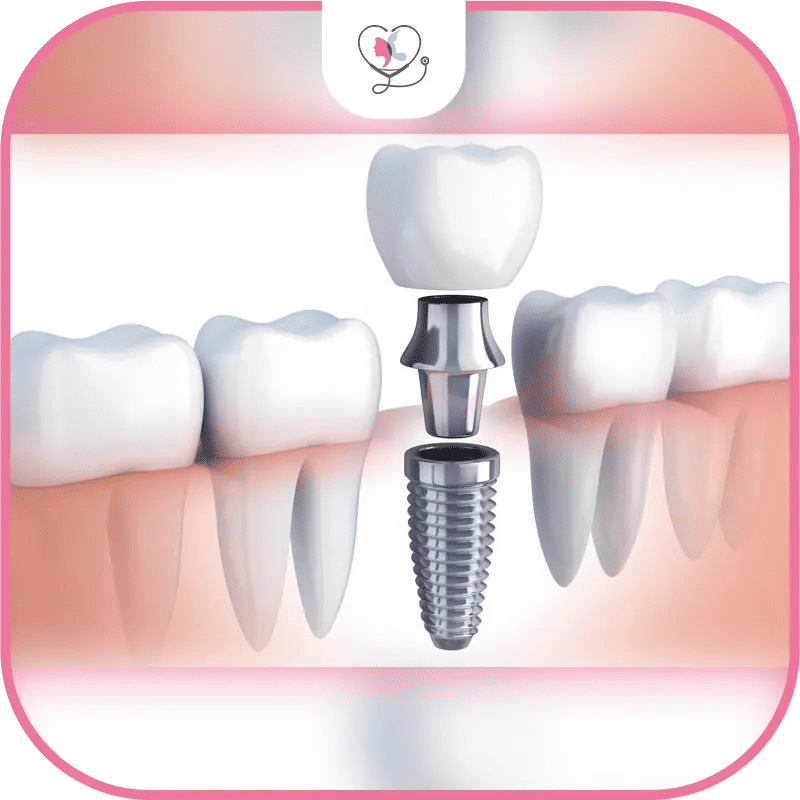 Same Day Dental Implants