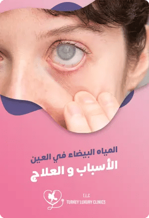 المياه البيضاء في العينfeatured image
