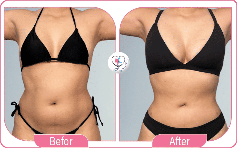 Avant / Après lipofilling mammaire du résultat du lipofilling mammaire