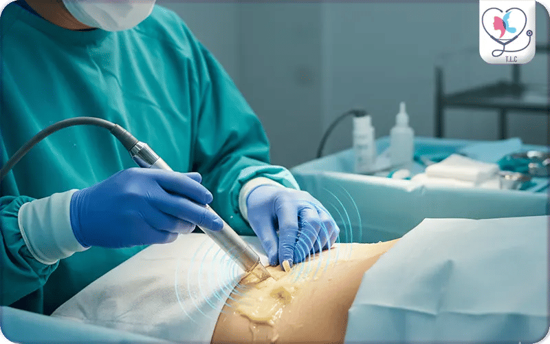 VASER Liposuction in Turkey at a Glance