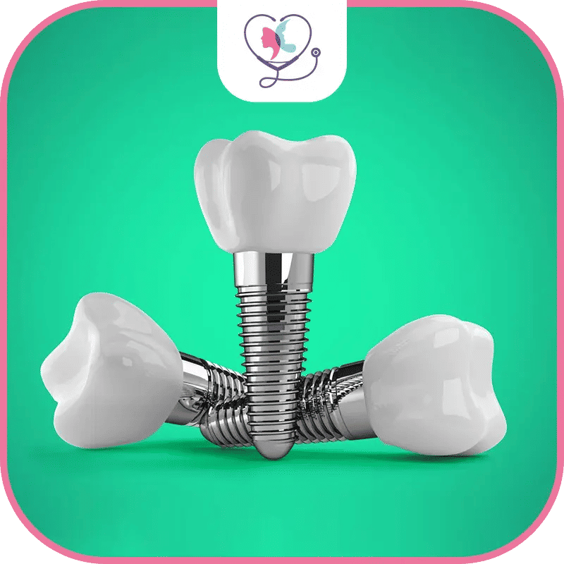 أنواع غرسات الأسنان الفورية في تركيا