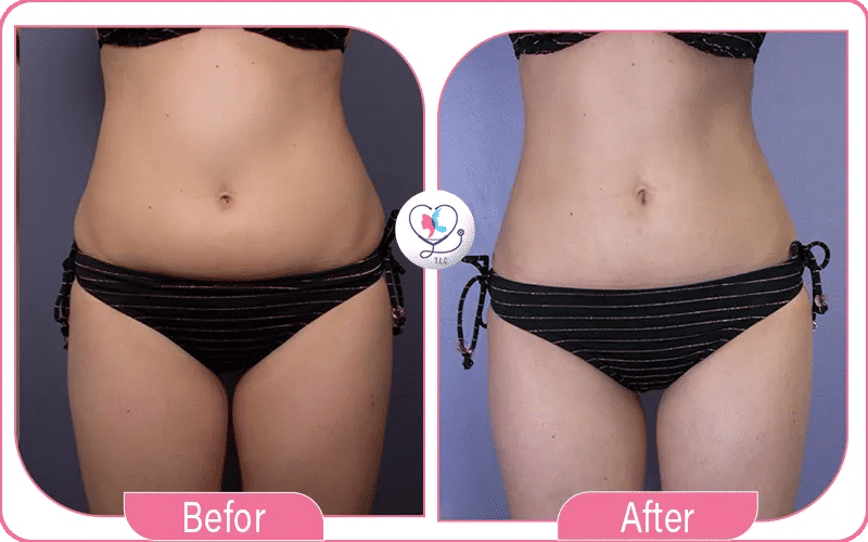 ثالثاً: شفط دهون الذراعين بالليزر