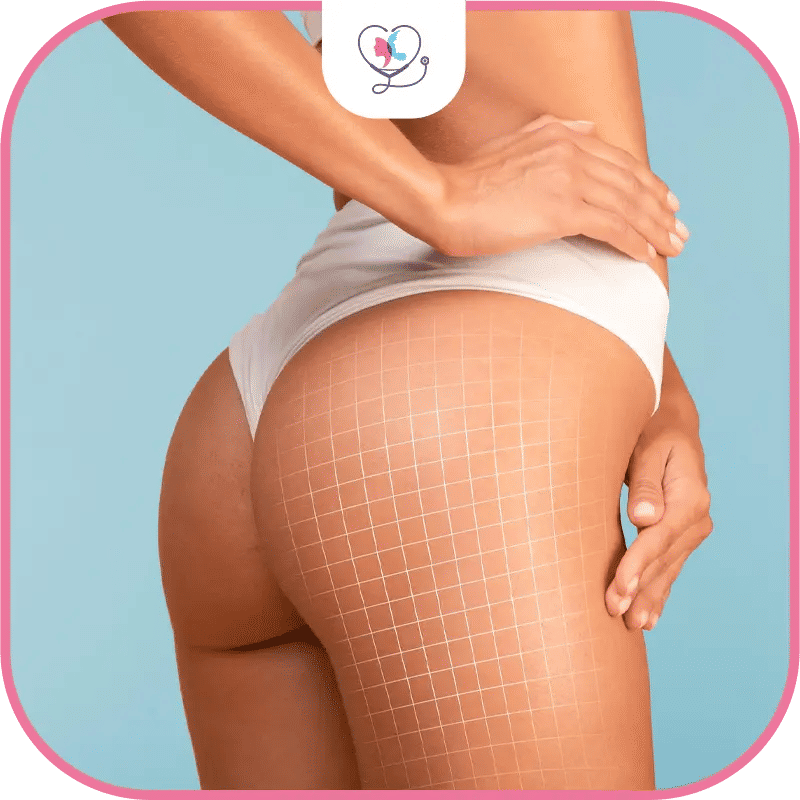 شفط دهون الارداف