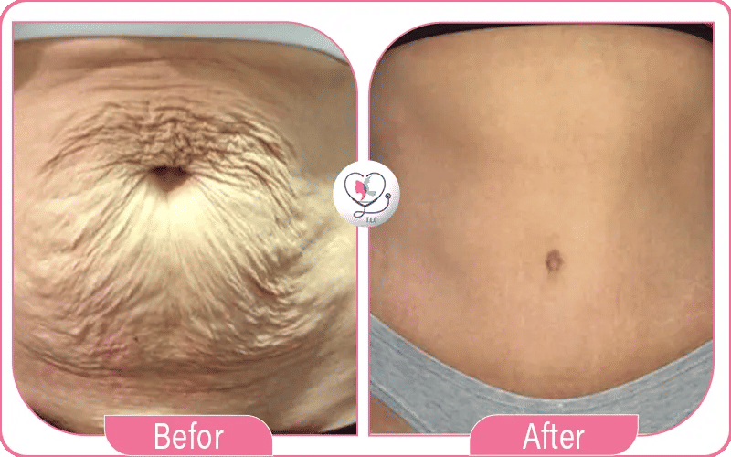 How to Fix a Weird Belly Button After a Tummy Tuck?