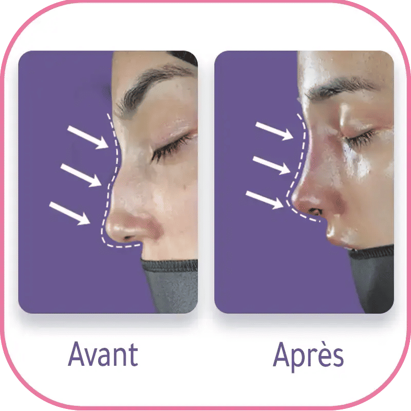 Pourquoi avoir recours à une rhinoplastie secondaire ?