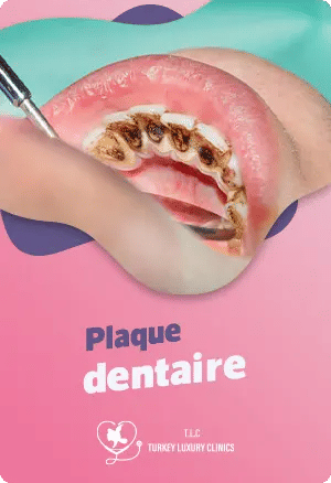 Plaque dentaire : qu'est-ce que c'est et comment l'éliminer ?