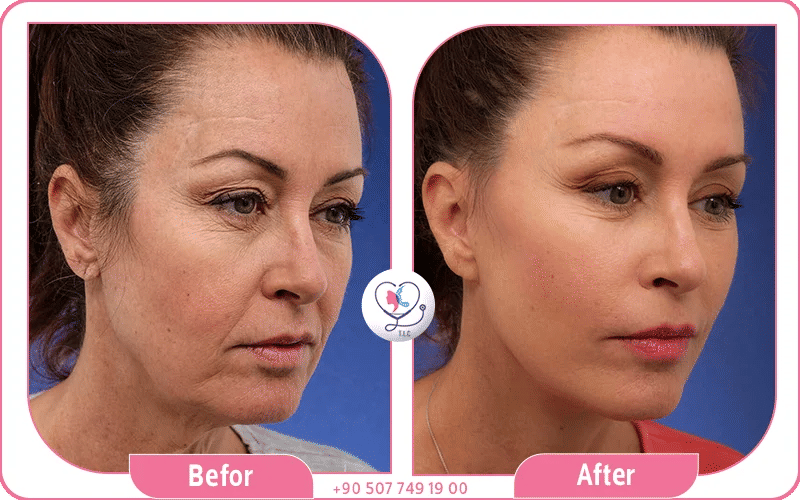 Best Facelift Surgeon and Clinics with Turkey Luxury Clinics