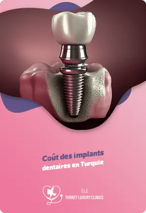 Coût des implants dentaires en Turquiefeatured image