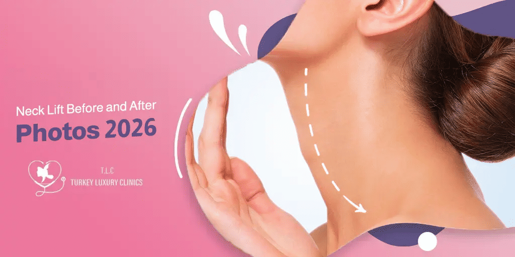 Neck Lift Before and After Photos 2026  