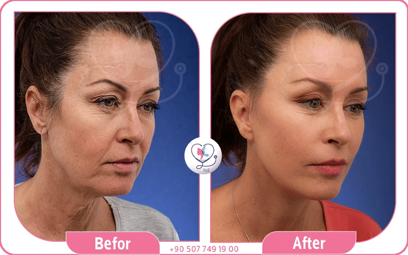 شد الوجه بالمنظار قبل وبعد