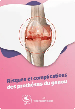 Risques et complications des prothèses du genoufeatured image