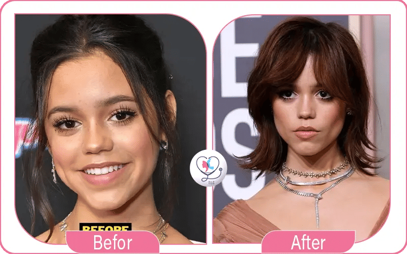 jenna ortega avant apres chirurgie esthétique-3