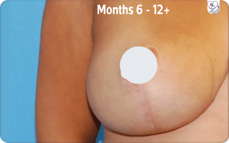 Maturation (Months 6   12+)