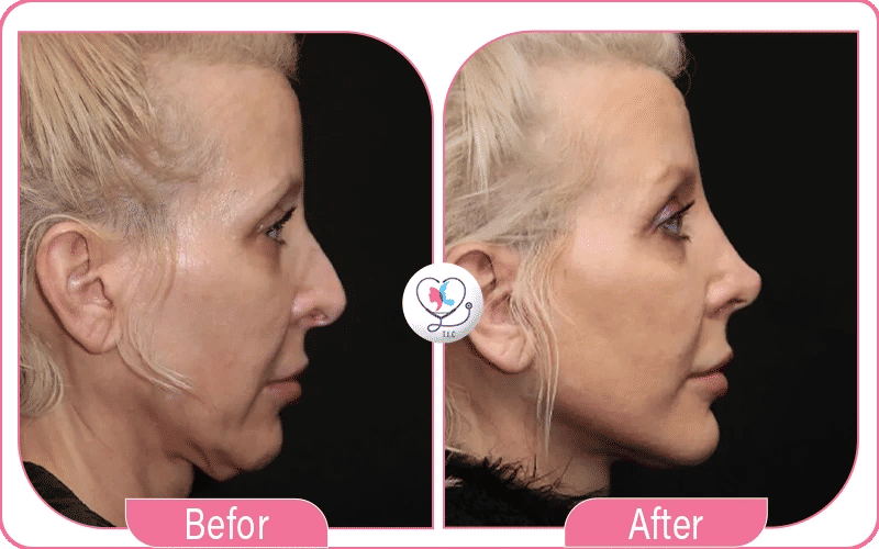 Localisation des Cicatrices après Mini Lifting du Visage-3