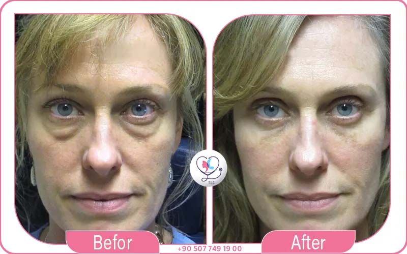 Blepharoplasty Cost in Turkey (2026)